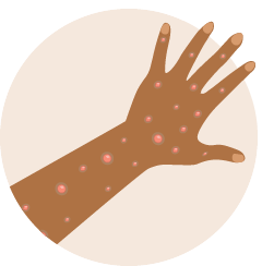 illustration of mpox bumps on arm